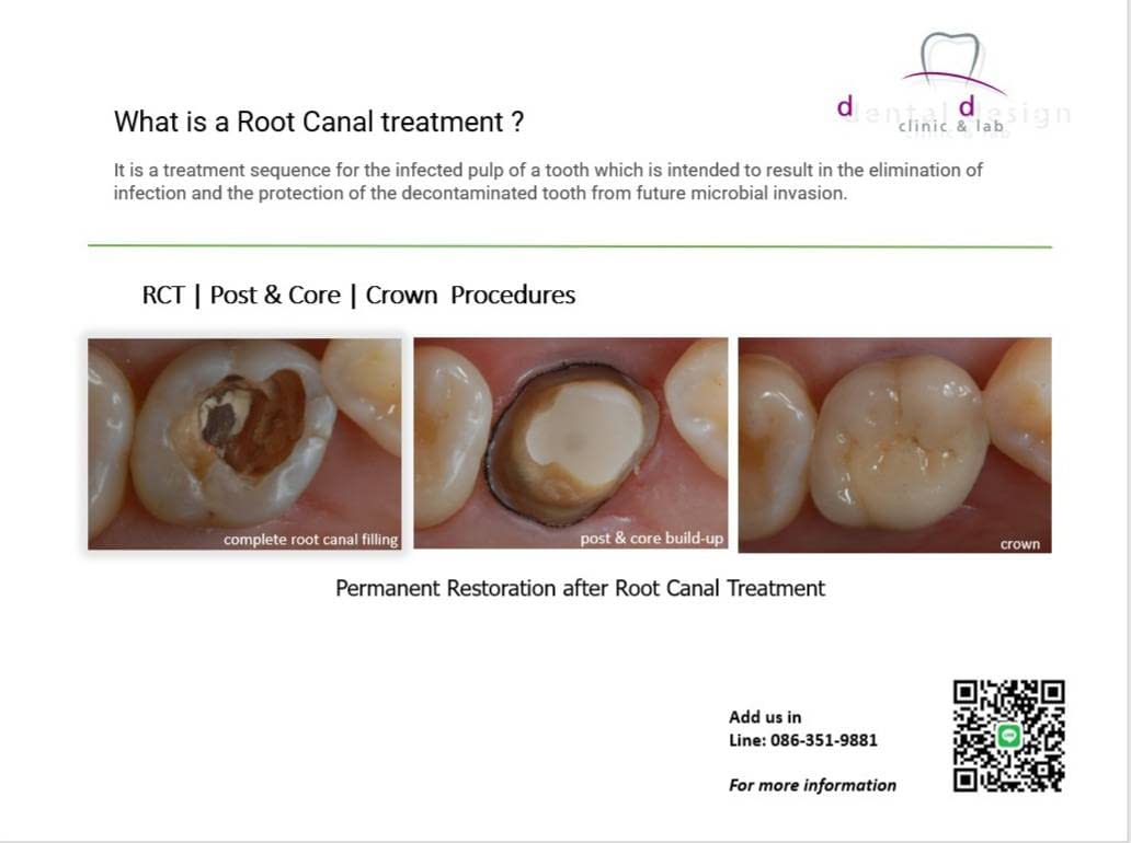 Root Canal Asoke, Bangkok Dental Design Clinic & Lab Highquality